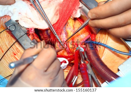 Heart surgery. Coronary artery bypass surgery. The most common heart surgery. Illustration for professionals.