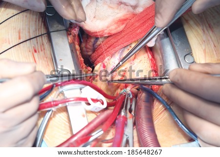Heart surgery. Open heart surgery. Coronary artery bypass surgery.