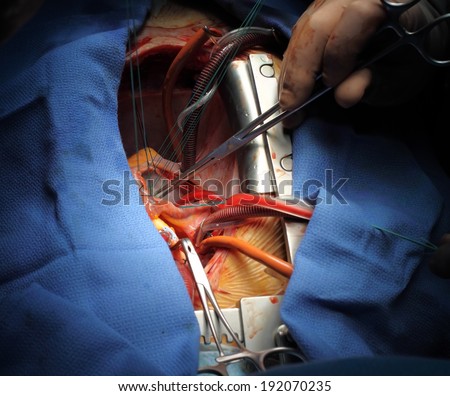 Heart surgery. Works in surgery