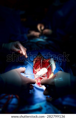 Teamwork surgeons during open-heart surgery