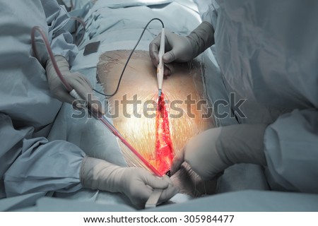 Surgeons work in the beginning of the surgery