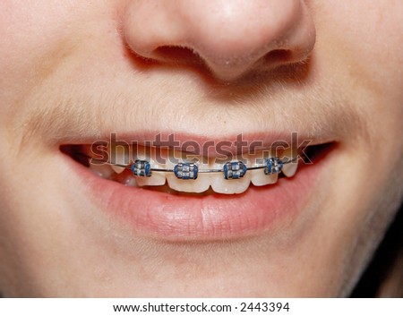 Close-up of a smiling young teenager with braces