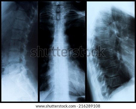 Negative x-ray skiagrames of the human spine (front and side views).