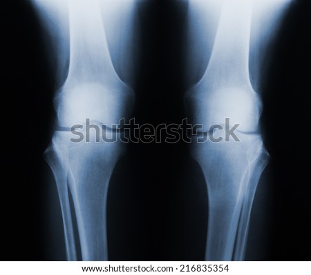 Negative x-ray skiagrames of the human knee joint (front view).