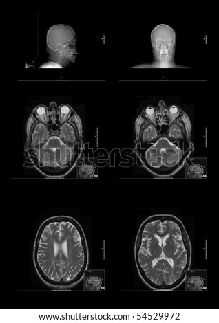 Six MRI (Magnetic Resonance Imaging) images of the human brain and head