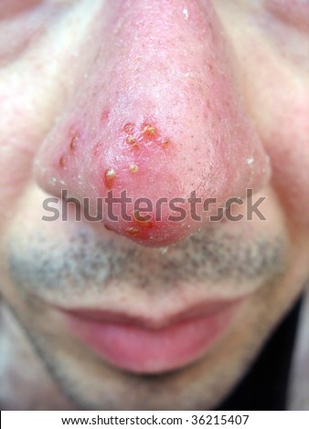 A medical condition closeup of the common cold sore virus herpes simplex on an infected victims nose. Triggers can be viral or from strong sun exposure. Also referred to as HSV1