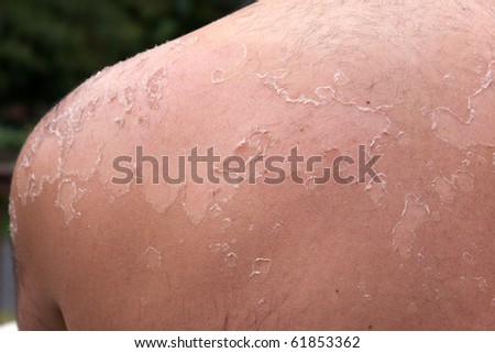Close up detail of a very bad sunburn showing the peeling blistered skin of a mans back.  Shallow depth of field.