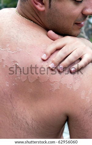 Close up detail of a very bad sunburn showing the peeling blistered skin of a mans back.  Shallow depth of field.