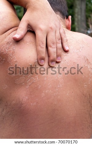 What To Do With Peeling Skin From Sunburn On Face