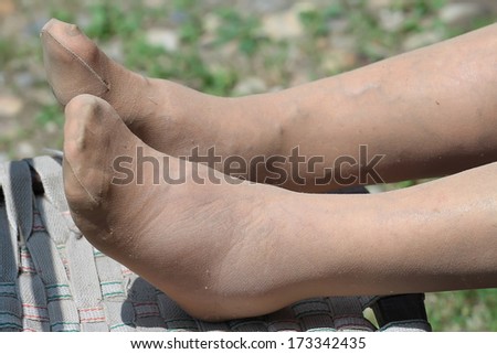 Blood circulation problem, swollen feet of a Senior woman