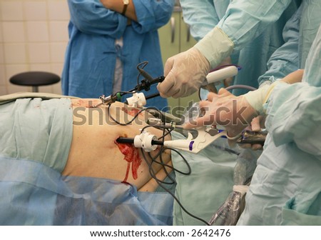 The nurse in a blue dressing gown observes complex laparoscopic operation
