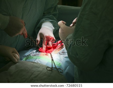 The surgeon operates on patient\'s deep at the abdominal cavity
