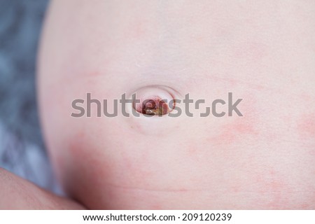 The dried stump of an umbilical cord in a newborn baby's belly button. The cord will eventually fall off. The skin on this baby's abdomen is also shedding, a typical stage of newborn development.