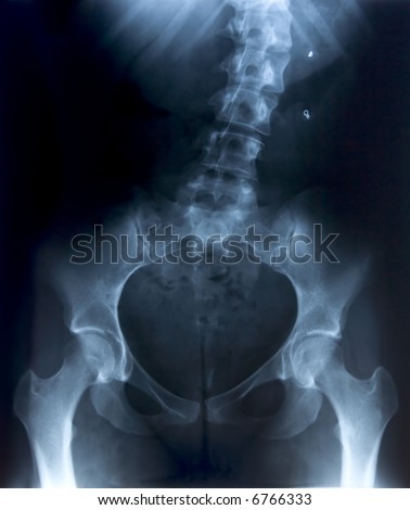 Female Pelvis X-Ray. Patient has curved spine. Surgical pins are visible.