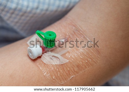 Close up capped off catheter into the vein