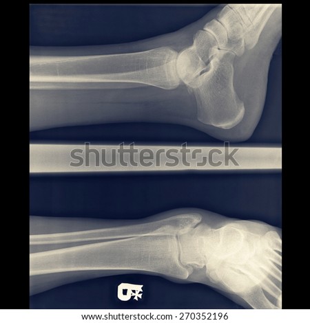 tearing of the joint capsule on authentic x-ray picture fracture fibula bone