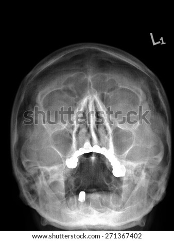 X-Ray image of human head and brain top view