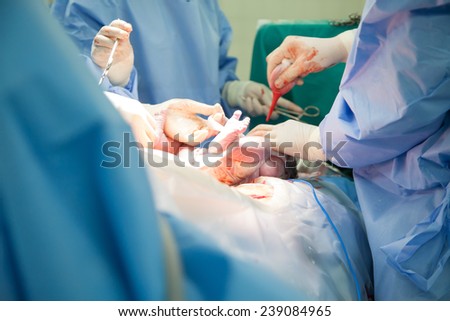 Doctor and nurse are  pulling a new born baby from mom\'s abdomen