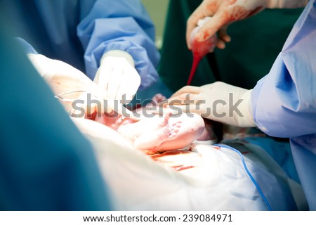 Doctor and nurse are  pulling a new born baby from mom\'s abdomen