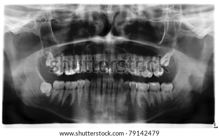 Teeth x-ray panorama