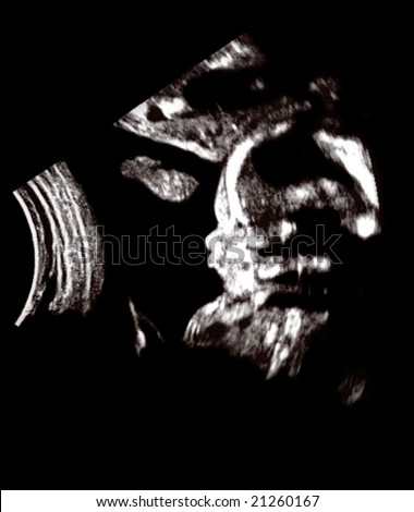 Ultrasound of a fetus at 20 weeks.  Baby profile.