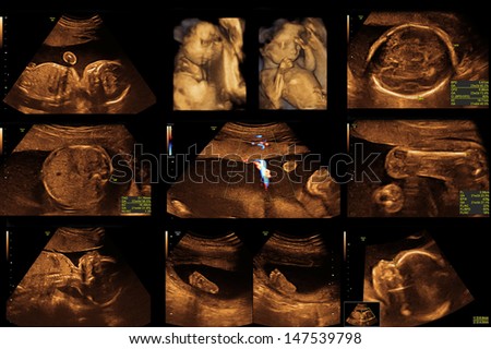 a baby on the ultrasound image
