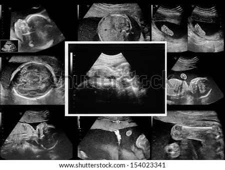 a baby on the ultrasound image