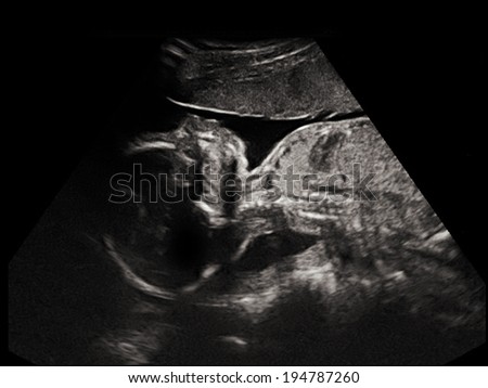 a child in the picture ultrasound