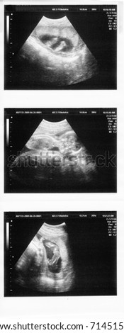 child in the picture ultrasound