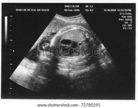 child in the picture ultrasound