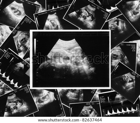 baby on an ultrasound image