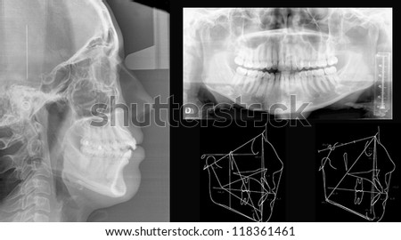 Panoramic dental X-Ray study Panoramic dental X-Ray study