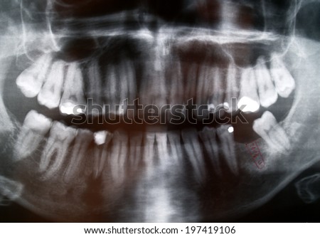 Panoramic dental X-Ray study with one missing piece