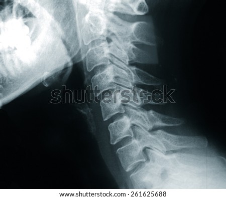 x-ray film of neck