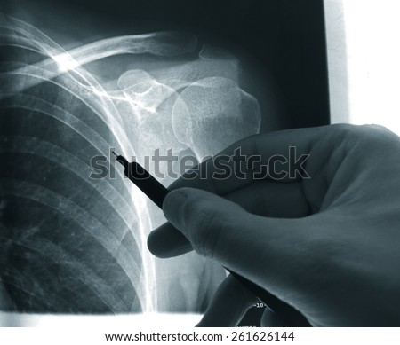 X-ray close up of shoulder and doctor\'s hand pointing