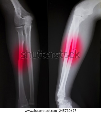 X-ray of both human arms (broken arm)