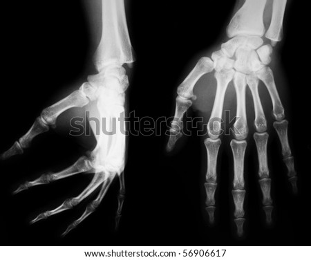X-ray of both human hands
