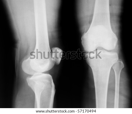 X-ray of both human knee