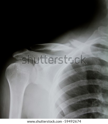 Shattered Shoulder