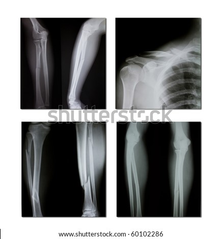 Broken X Ray