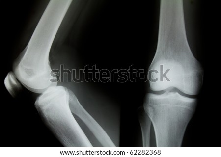 X-ray of both human knee.