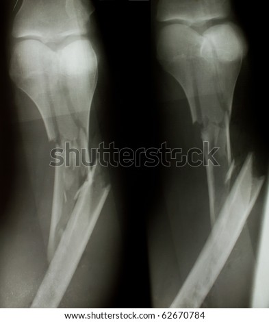X-ray of both human legs (fractures).