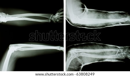 X-ray of both human arms (normal arms and arms with splint).