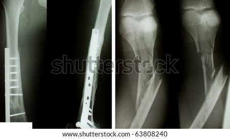 X-ray of both human legs (fractures).