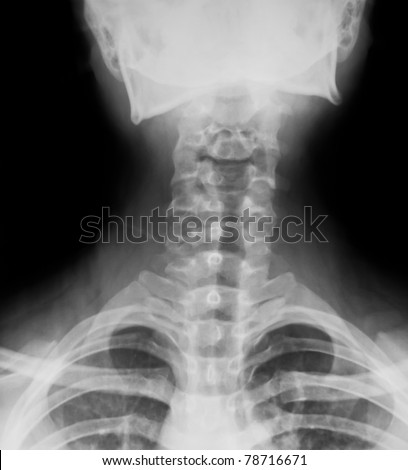 Detail of neck x-ray image.
