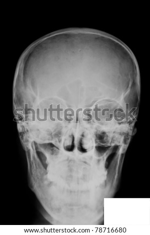 front of skull