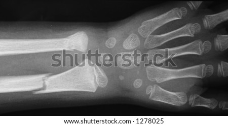 Young child\'s forearm fractured. The wrist bones are still cartilagenous.