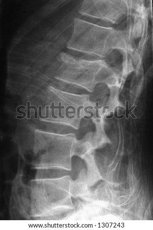 Side Spine X-Ray Stock Photo 1307243 : Shutterstock