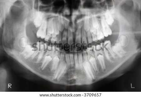 x-ray of jaw with two pairs of teeth (milk teeth and regular teeth), soft focus