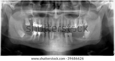 X-ray of jaw with missing teeth